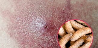 SSA confirma 8 casos de gusano barrenador en humanos; mayoría de afectados presentaron miasis en la cabeza