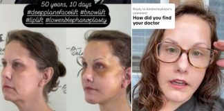 Mujer de 50 años es viral por su cirugía de rostro que le costó casi 300 mil pesos, aseguran que rejuveneció 30 años