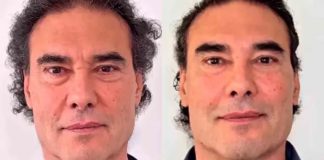 Eduardo Yáñez estrena rostro tras someterse a rejuvenecimiento facial