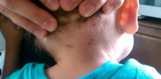 Niño de 9 años perdió la vida por Rickettsia (mordedura de garrapatas o piojos); estos fueron sus síntomas antes de fallecer