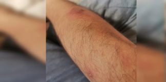 Confirma Salud Jalisco primera muerte en 2025 por Mpox