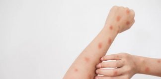 Viruela del mono repunta en Tamaulipas: detectan cuatro casos activos