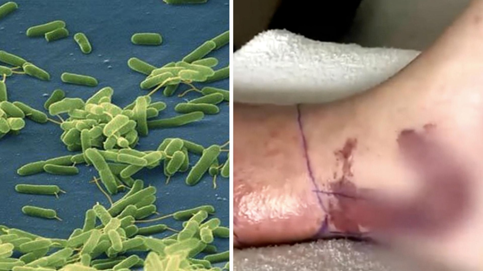 Alerta por una bacteria carnívora presente en el agua del mar: suben a ocho  las muertes en EEUU - nuevolaredo.tv