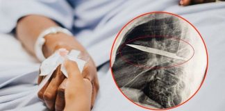 Hombre va al médico por un fuerte dolor en el pecho y descubren que tenía un cuchillo atravesado desde hace 10 años