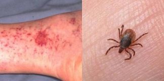 Joven muere a los 17 años por complicaciones de Rickettsia en Tijuana, una garrapata estaría detrás de esta rara enfermedad