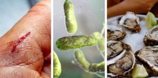 Alertan por peligrosa bacteria come carne por mariscos contaminados, ya suman 6 muertos