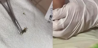 ¿Un cangrejo en la oreja? El impactante video del niño que terminó en el hospital