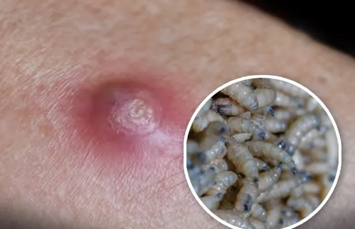 Gusano barrenador en Chiapas: mueren otras 3 personas que fueron portadoras de este mal