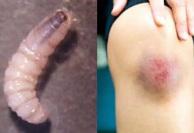 Oaxaca confirma dos casos de gusano barrenador en humanos; ambos pacientes se encuentran recuperados