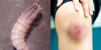 Oaxaca confirma dos casos de gusano barrenador en humanos; ambos pacientes se encuentran recuperados