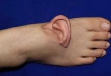 Obrera pierde una oreja al atorarse en una máquina y se la colocan en el pie