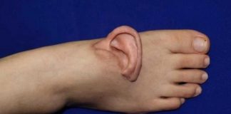 Obrera pierde una oreja al atorarse en una máquina y se la colocan en el pie
