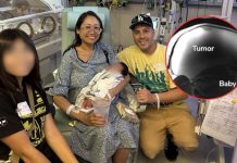 Mujer entra a quirófano para quitarse tumor de 10 kg y descubren un bebé: “un embarazo fuera del útero”