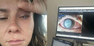 Parásito devora ojo de joven tiktoker y hoy alerta sobre el uso de lentes de contacto