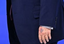 ¿Qué le pasó a Trump en la mano? Esto le causó un moretón al presidente de Estados Unidos