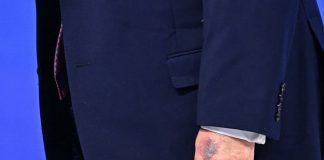 ¿Qué le pasó a Trump en la mano? Esto le causó un moretón al presidente de Estados Unidos