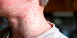 Tamaulipas contiene brote nacional de sarampión; refuerzan vigilancia epidemiológica