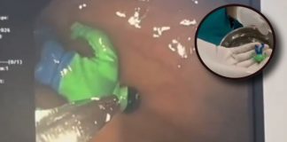 VIDEO: Llevan a hospital a niño con fuerte dolor y doctores encuentran un ‘Hulk’ en su estomago
