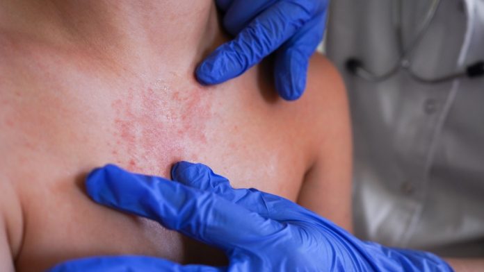 Confirman primera muerte por sarampión en Durango en 2026; era un niño de 8 años