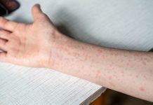 Investigan una posible segunda muerte por sarampión en CDMX; reportan 263 contagios