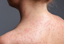 Sinaloa confirma primera muerte por sarampión; van 34 en México