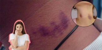 Adolescente muere tras recibir un “chupetón” en el cuello, ¿cuáles son los riesgos de esta práctica?
