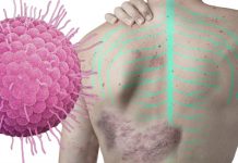 ¿Te dio varicela de niño? Cuidado: podrías padecer herpes zóster de adulto