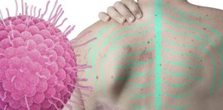 ¿Te dio varicela de niño? Cuidado: podrías padecer herpes zóster de adulto