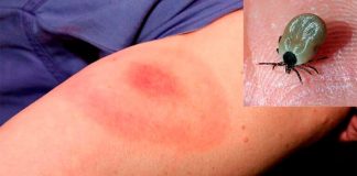 Alertan por casos de rickettsiosis