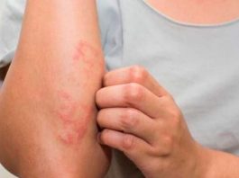 Enfermedades de la piel aumentan en Tamaulipas por calor extremo