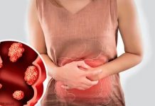¿Qué tipo de cáncer causa diarrea?