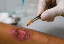 Confirman autoridades de Salud fallecimiento de mujer con gusano barrenador en Tamaulipas; pero descartan muerte por la infección