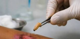 Confirman autoridades de Salud fallecimiento de mujer con gusano barrenador en Tamaulipas; pero descartan muerte por la infección