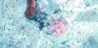 Confirman 12 casos de ciclospora y siete sospechosos en Laredo
