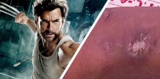 Adolescente termina en el hospital tras inyectarse mercurio para convertirse en Wolverine